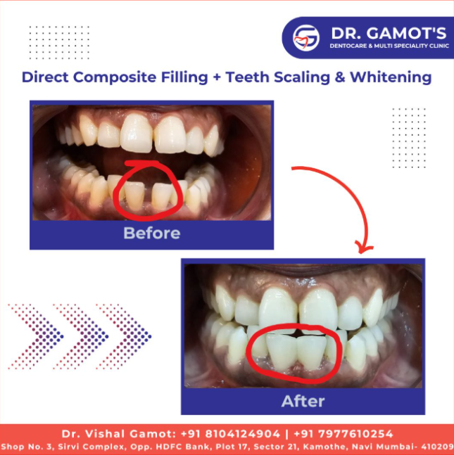 Direct composite filling and teeth whitening before and after