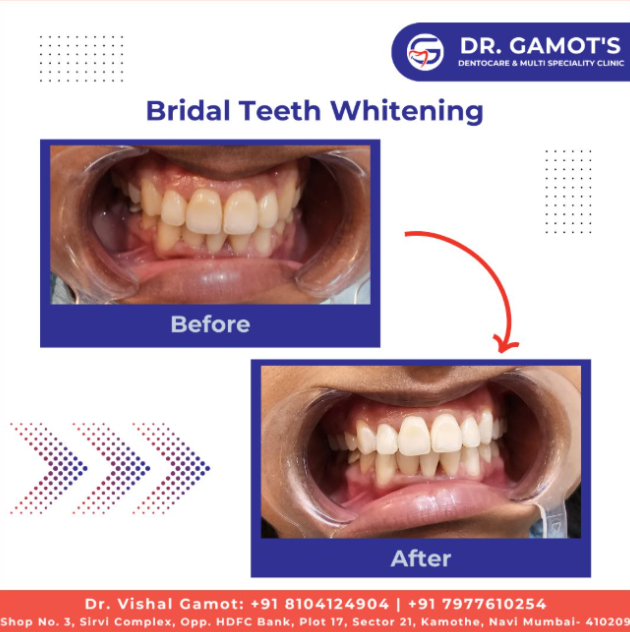Bridal teeth whitening before and after